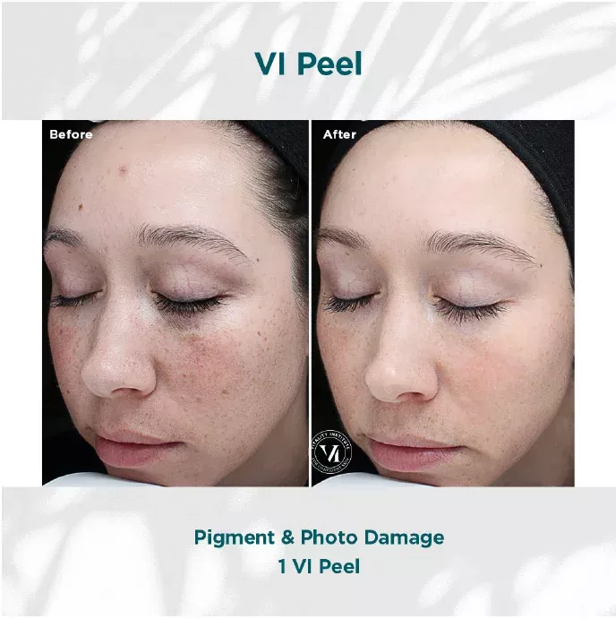 VI Peel Pigment and Photo Damage